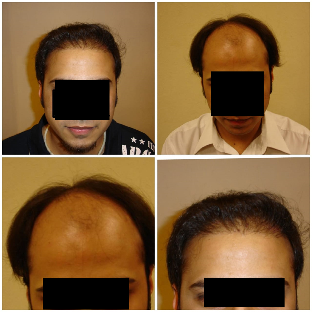 Hair Transplant in Pakistan by Dr shehab beg