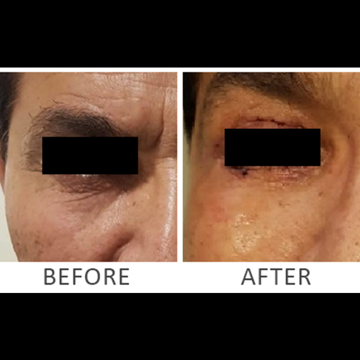 Blepharoplasty Baggy Eyelid Procedures | Before After Result