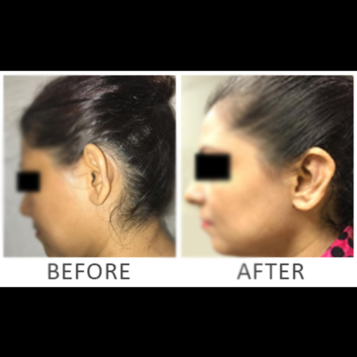 Prominent Ear Procedure | Before/After Result ​