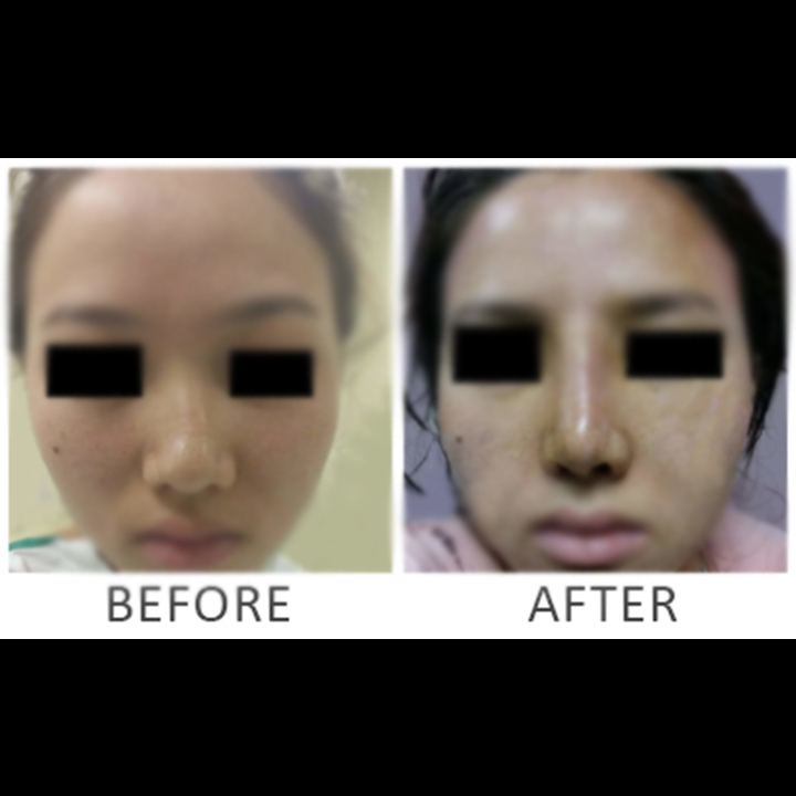 Liposuction Procedure Before/After Results