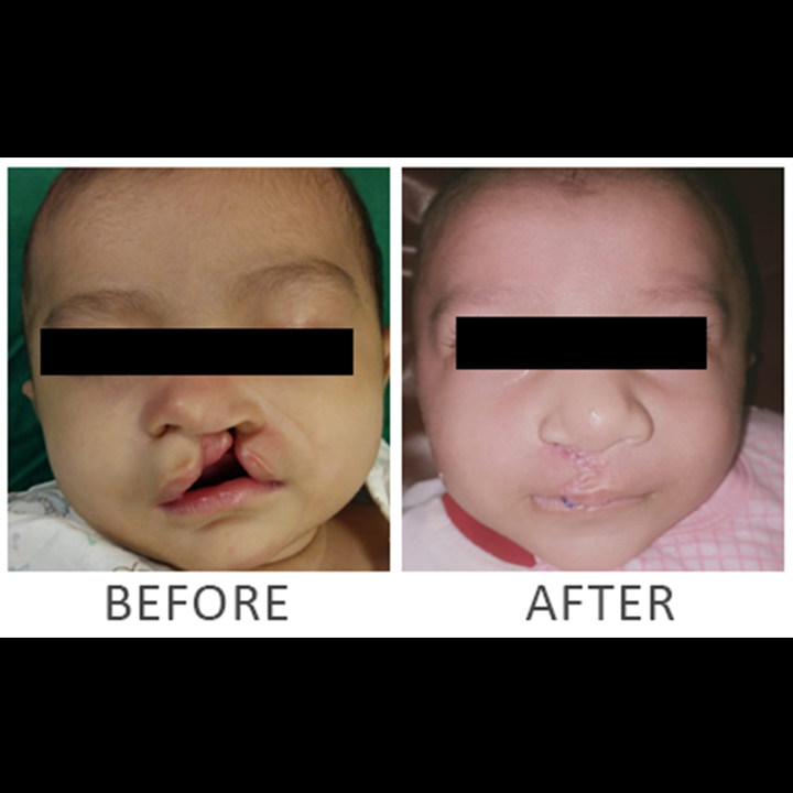 Cleft Lip | Lip Augmentation | Before/After Result ​
